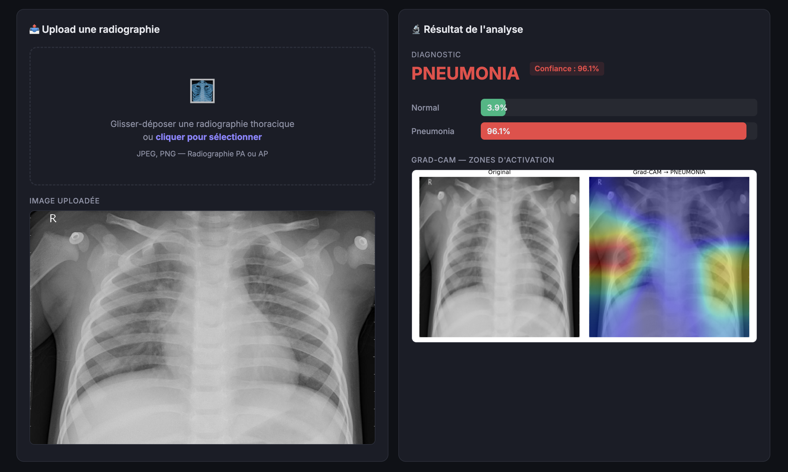 Dashboard de prédiction en direct : upload d'une radiographie, diagnostic PNEUMONIA à 96,1 % de confiance, et carte Grad-CAM montrant les zones d'activation du modèle.
