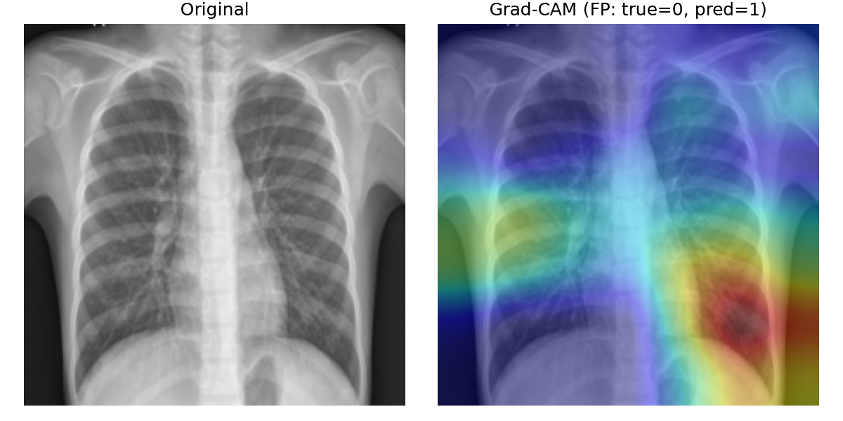 Grad-CAM sur un faux positif : le modèle active une zone qui n'est pas pathologique, illustrant les limites du pré-screening.