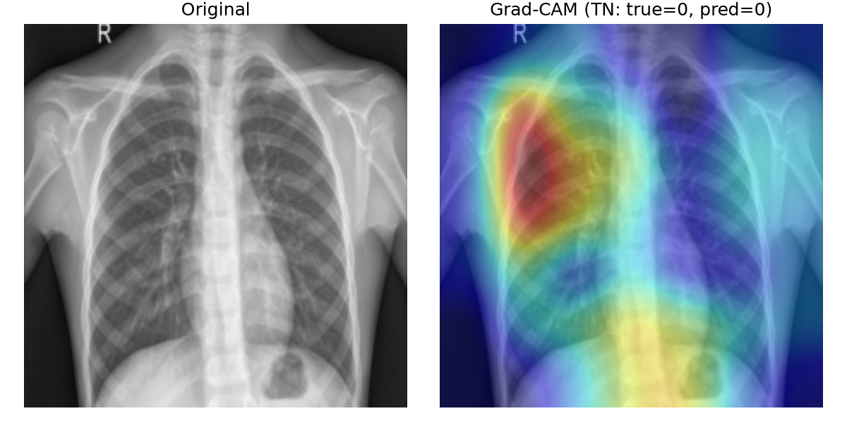 Grad-CAM sur un vrai négatif : activation diffuse sur un poumon sain, sans concentration sur une zone pathologique.
