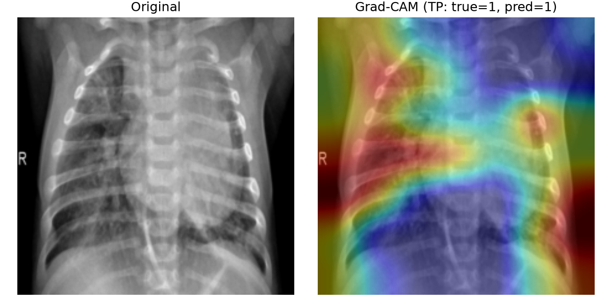 Grad-CAM sur un vrai positif : la carte d'activation se concentre sur les opacités pulmonaires, confirmant la détection correcte de pneumonie.